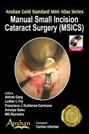 Manual Small Incision Cataract Surgery (MSICS)